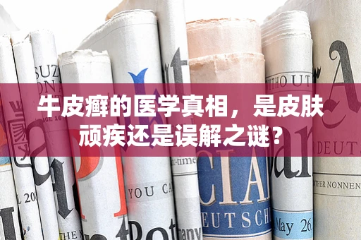 牛皮癣的医学真相，是皮肤顽疾还是误解之谜？